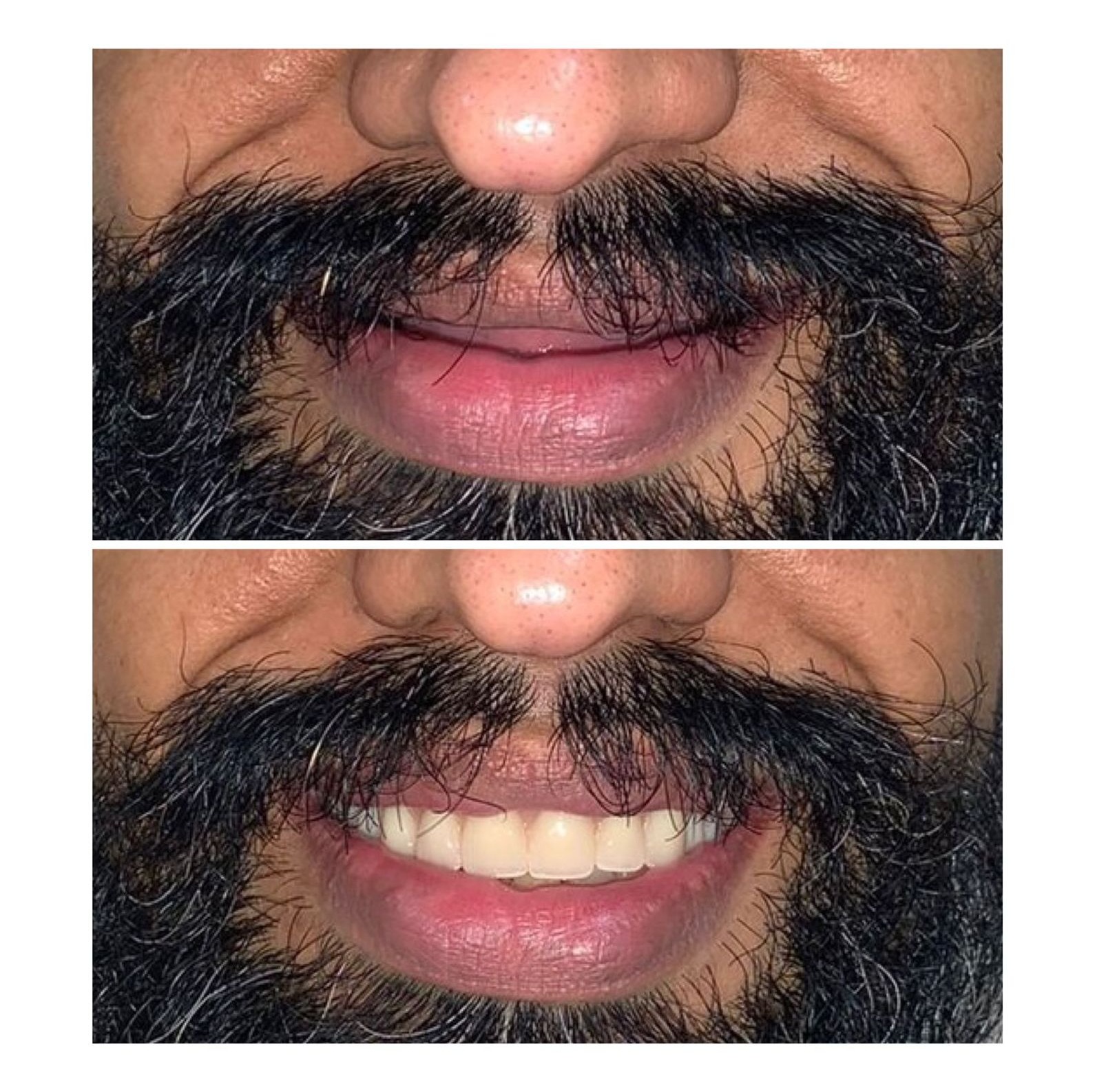 Complete smile transformation before and after at Ray Dentistry Mogappair