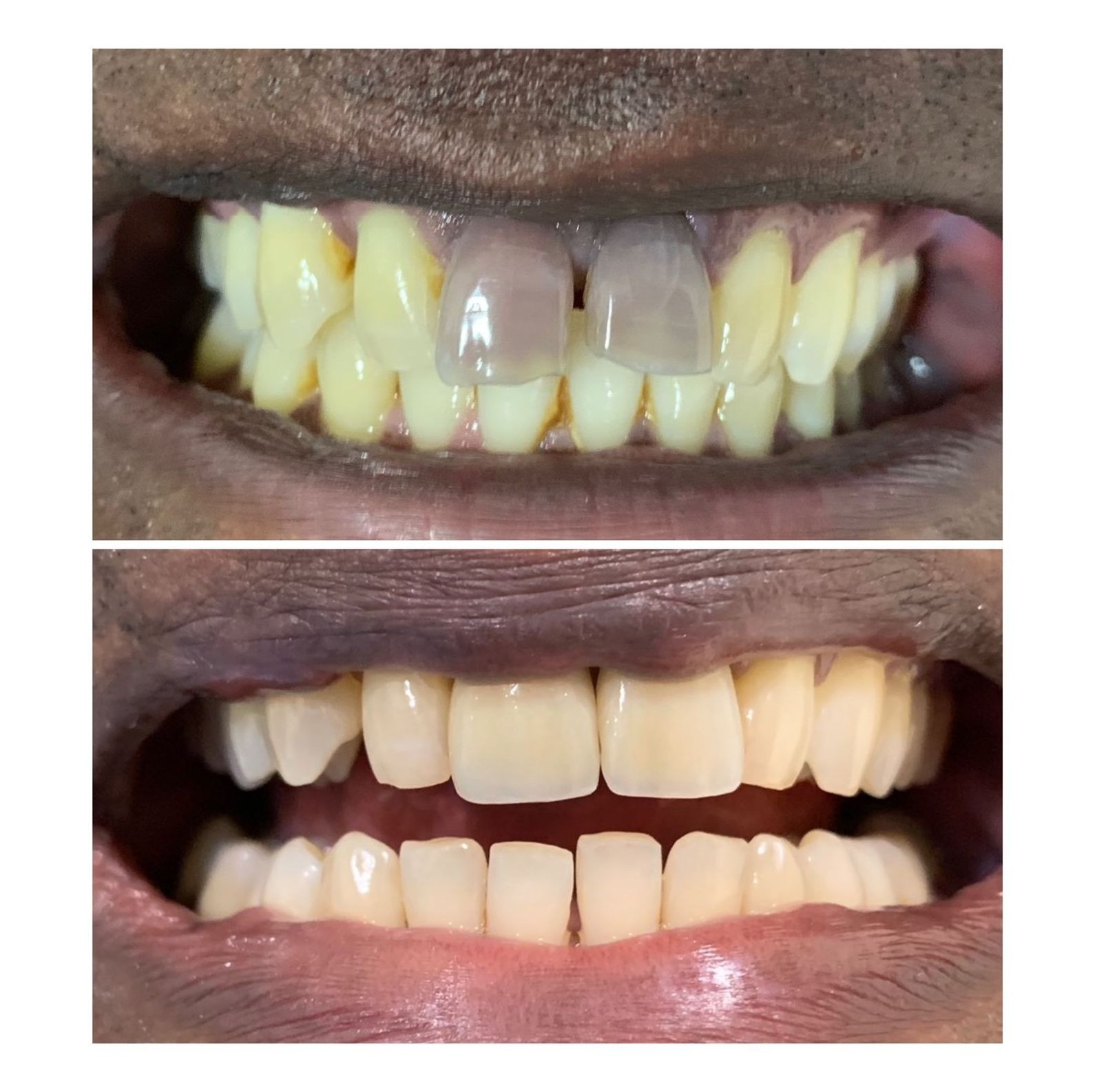 Crown and veneer restoration before and after at Ray Dentistry Chennai