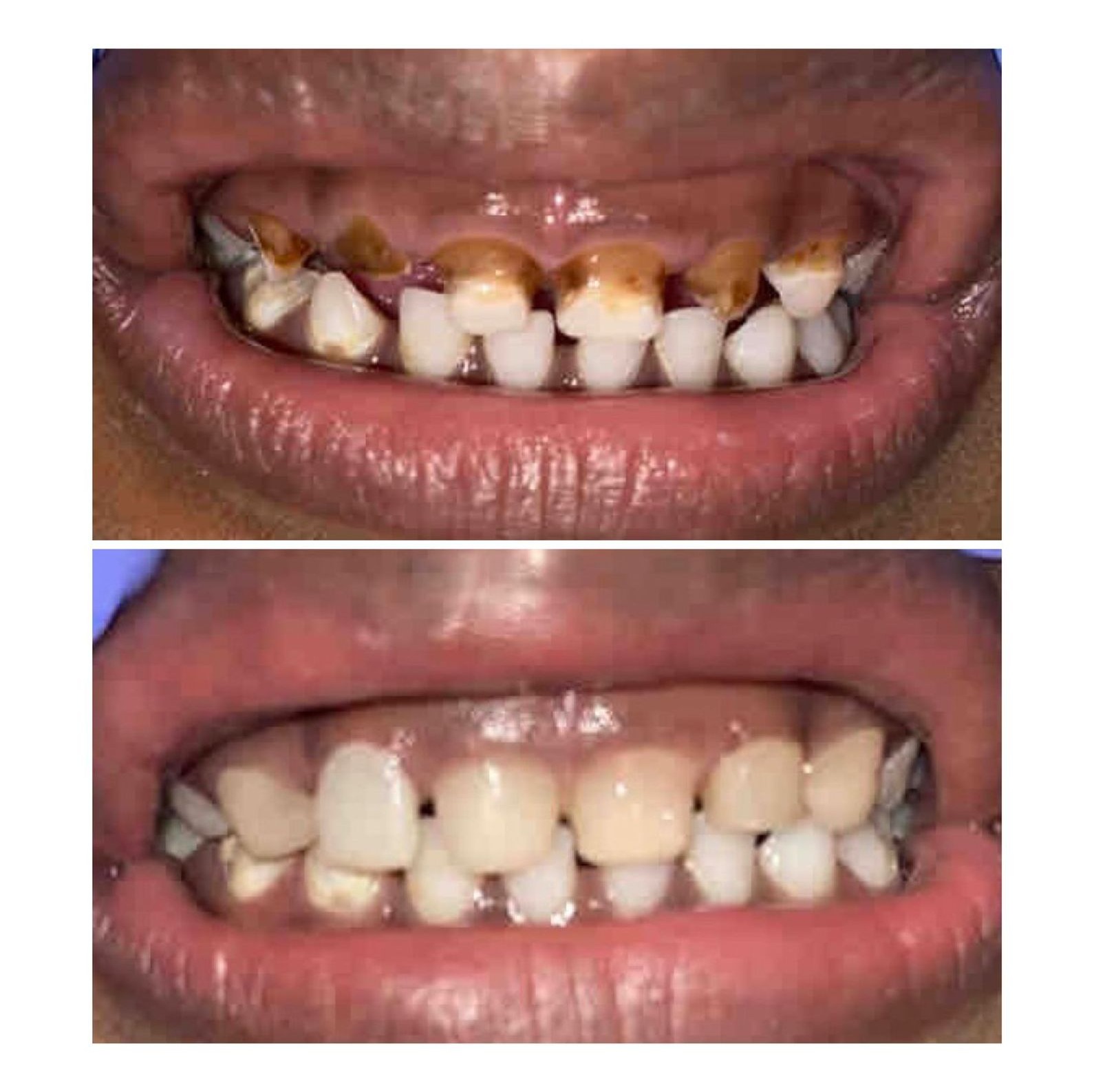 Dental restoration before and after at Ray Dentistry Mogappair