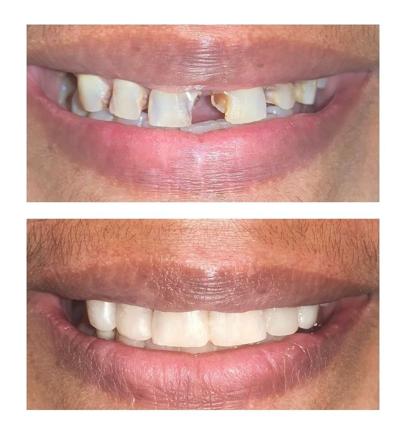 Smile makeover before and after — crown and bridge work at Ray Dentistry Chennai