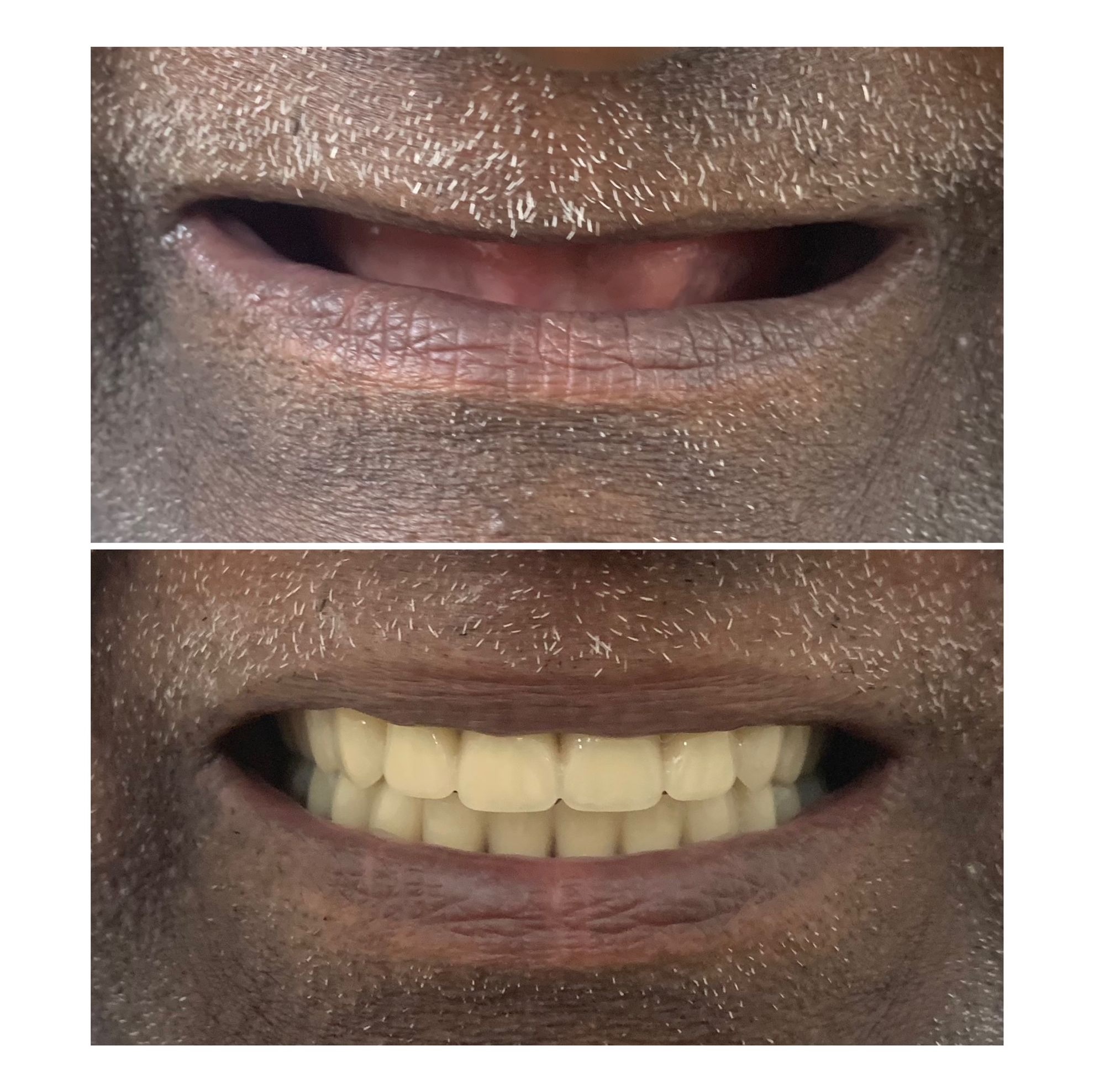 Full denture before and after results at Ray Dentistry Chennai