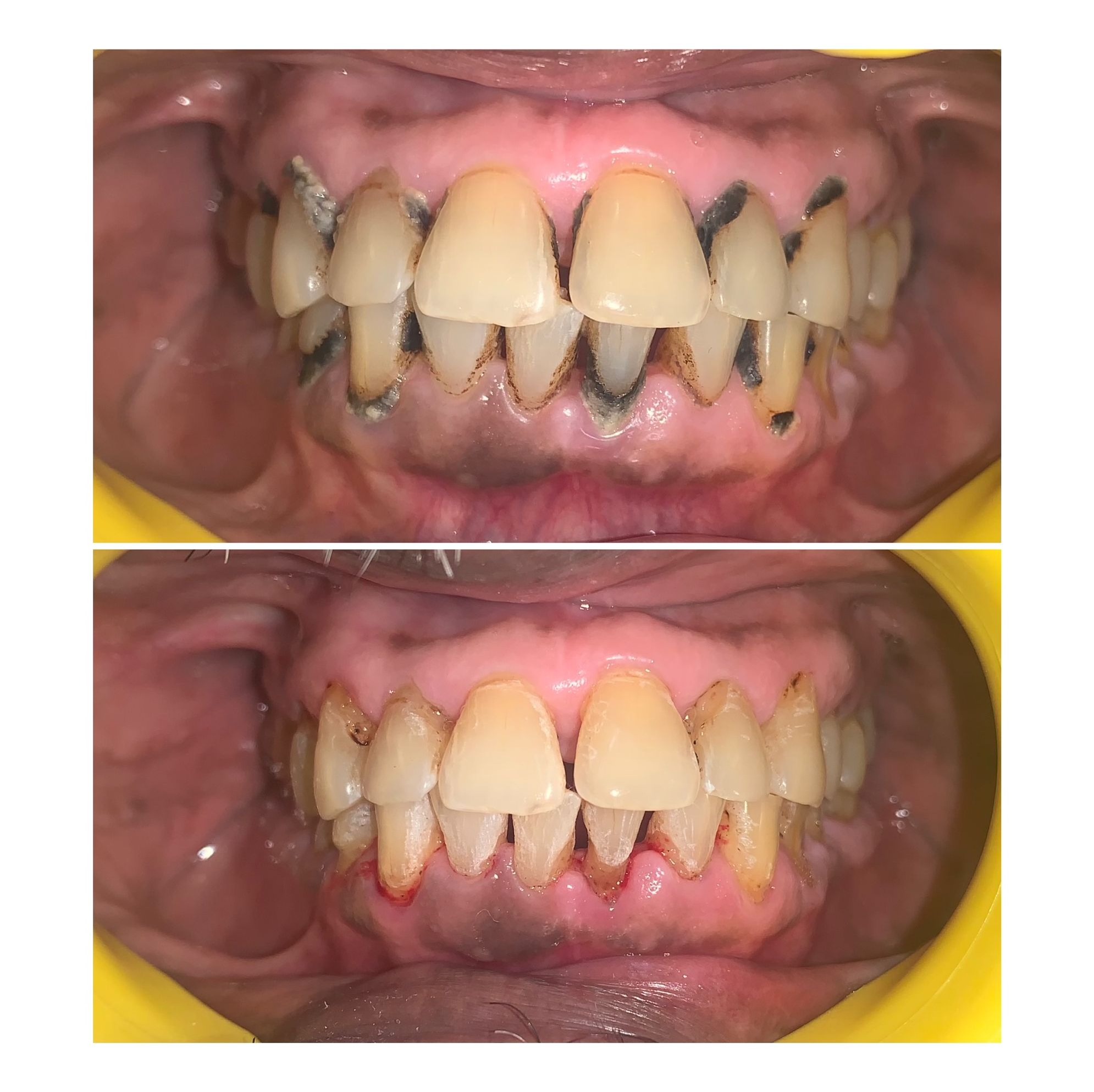 Teeth scaling and cleaning before and after at Ray Dentistry Mogappair