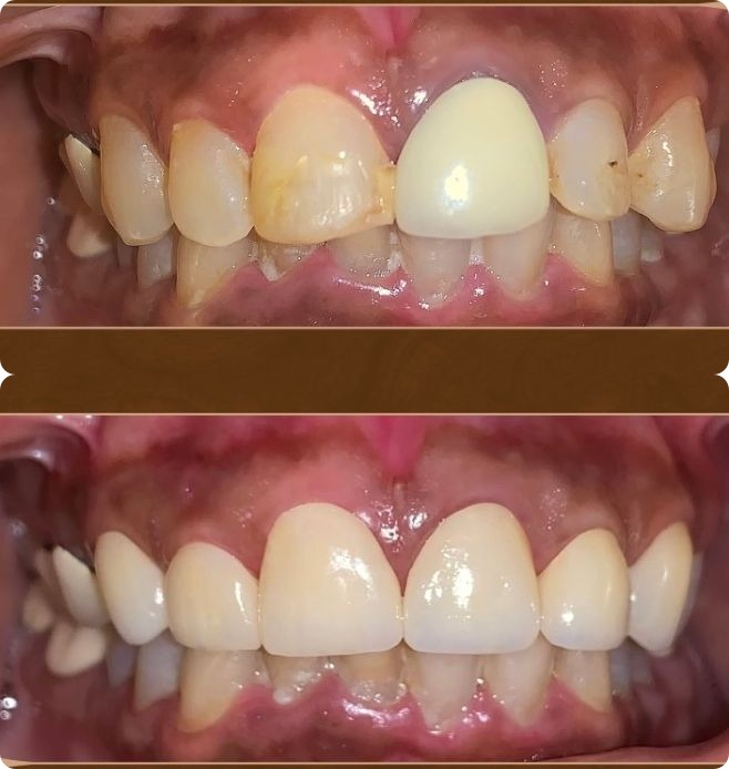 Dental veneer and crown work before and after at Ray Dentistry Mogappair